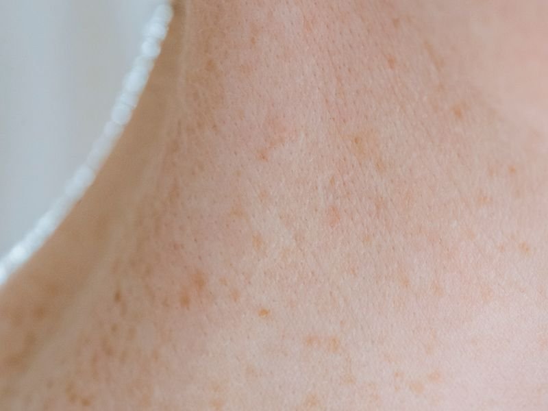 Consultation and patch test